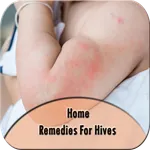 Home Remedies For Hives icon