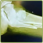 Fracture icon