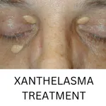 XANTHELASMA TREATMENT icon