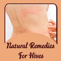 Natural Remedies For Hives icon
