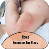 Home Remedies For Hives icon