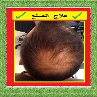 علاج الصلع بالأعشاب الطبيعية icon