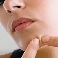 Acne Pimple Treatment icon