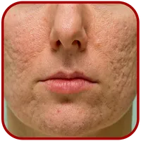 Acne Scar Removal icon