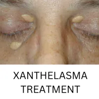 XANTHELASMA TREATMENT icon