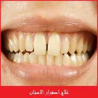 علاج اصفرار الاسنان icon