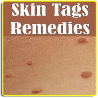 Skin tags Treatment and Home R icon