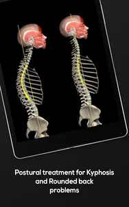 Kyphosis & Rounded Back by M&M screenshot 10