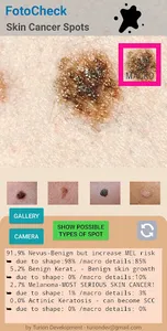 FotoCheck Skin Cancer Spots ID screenshot 1