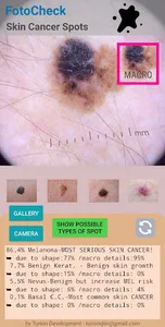 FotoCheck Skin Cancer Spots ID screenshot 2