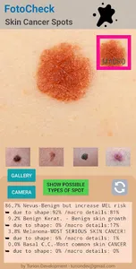 FotoCheck Skin Cancer Spots ID screenshot 3