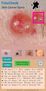 FotoCheck Skin Cancer Spots ID screenshot 4