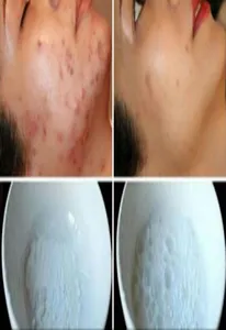 facial acne screenshot 0