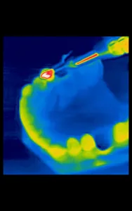Dental Thermal App screenshot 11