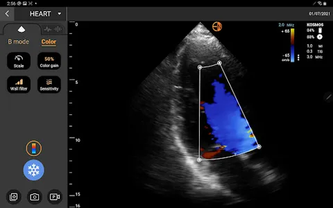 EchoNous Kosmos Ultrasound screenshot 2