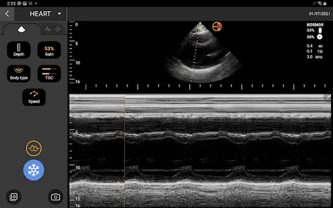 EchoNous Kosmos Ultrasound screenshot 3