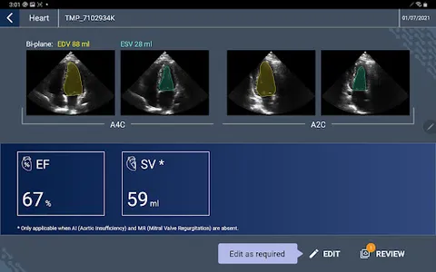 EchoNous Kosmos Ultrasound screenshot 6