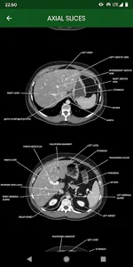 abdominal CT: annotated slices screenshot 2