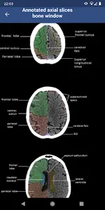 Brain CT : annotated slices screenshot 2