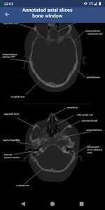 Brain CT : annotated slices screenshot 3