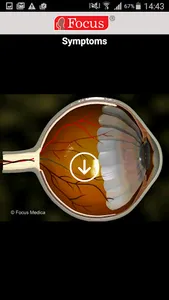 Glaucoma (An Overview) screenshot 2