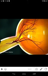 Glaucoma (An Overview) screenshot 7