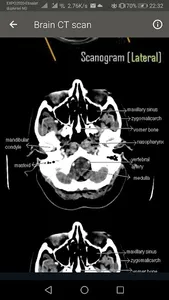 CT Scan of Brain screenshot 1