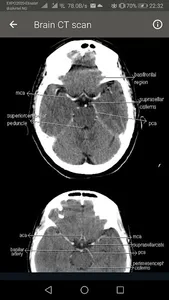 CT Scan of Brain screenshot 2