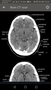 CT Scan of Brain screenshot 3