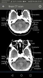 CT Scan of Brain screenshot 4