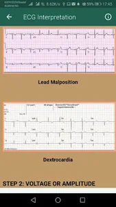 ECG Interpretation Part 1 screenshot 6