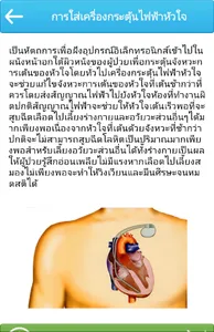 การใส่เครื่องกระตุ้นไฟฟ้าหัวใจ screenshot 1