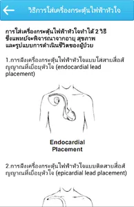 การใส่เครื่องกระตุ้นไฟฟ้าหัวใจ screenshot 2