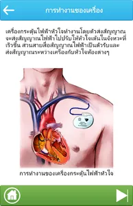 การใส่เครื่องกระตุ้นไฟฟ้าหัวใจ screenshot 4