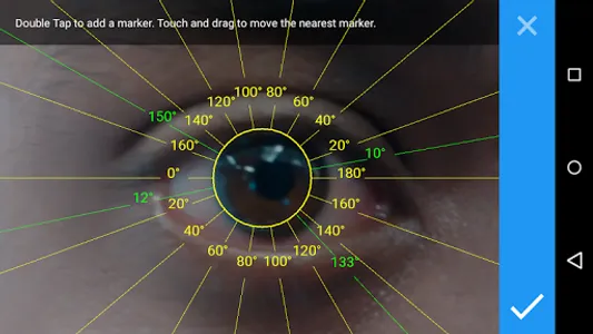 Toric IOL Axis Marker screenshot 4