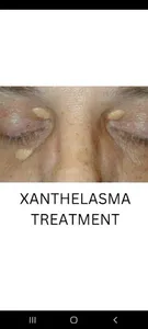 XANTHELASMA TREATMENT screenshot 3