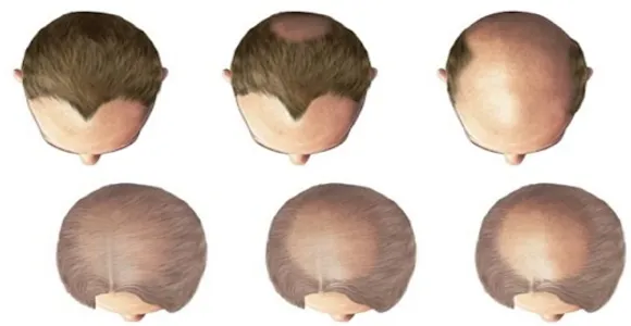 7 Ways to get hair back. screenshot 1