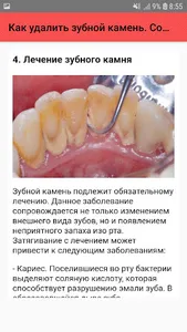 Как удалить зубной камень screenshot 4