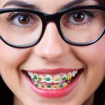 Braces on teeth – Stickers AI icon