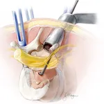 Metastatic Spine icon