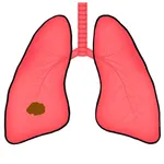 Lung TNM icon