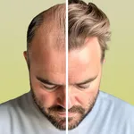 HairCode: AI Hair Loss Scanner icon