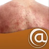 Atopic Dermatitis icon