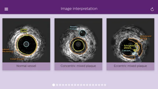 Philips Coronary IVUS Tutor screenshot 3