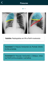 Thorax - thoracic radiology screenshot 2