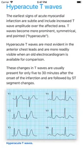 ECG Basics Lite: ECG Made Easy screenshot 3