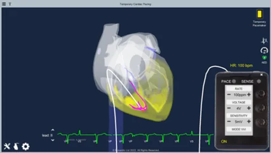 Temporary Cardiac Pacing screenshot 0