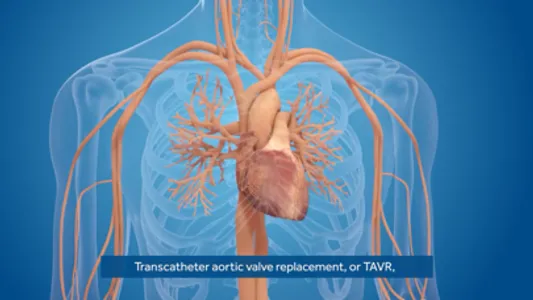 AS TAVR Education screenshot 2