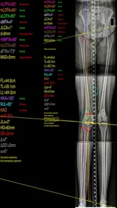 OsteotomyApp screenshot 1