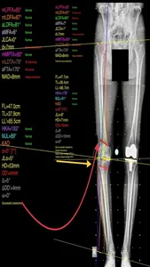 OsteotomyApp screenshot 2